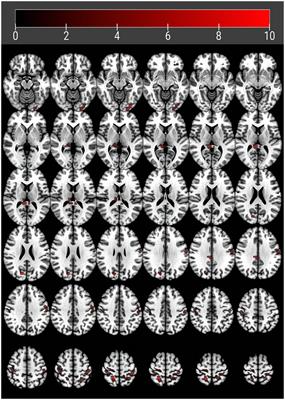 Aberrant baseline brain activity and disrupted functional connectivity in patients with vascular cognitive impairment due to cerebral small vessel disease
